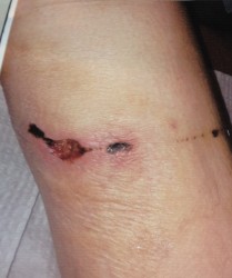 Mary Stanley suffered multiple bite wounds around the middle of her right leg