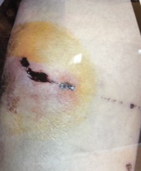 Mary Stanley continues to undergo wound care therapy for the dog bite wounds on her leg